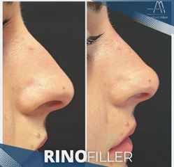 Rinofiller - Dott. Alfredo Altieri