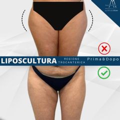 Dott. Alfredo Altieri Liposcultura