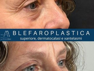 Blefaroplastica prima e dopo - 879710