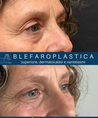 Dott. Alfredo Altieri Blefaroplastica superiore dermatocalasi