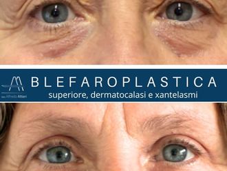 Blefaroplastica prima e dopo - 879711