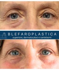 Dott. Alfredo Altieri Blefaroplastica superiore dermatocalasi