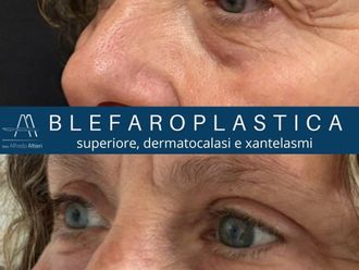 Blefaroplastica prima e dopo - 879712