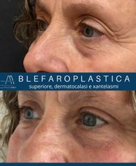 Dott. Alfredo Altieri Blefaroplastica superiore dermatocalasi