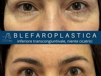 Blefaroplastica prima e dopo - 879713