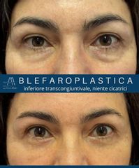 Dott. Alfredo Altieri Blefaroplastica inferiore transcongiuntivale