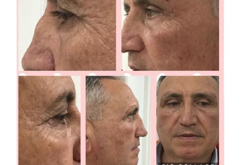 Rughe prima e dopo - 767041