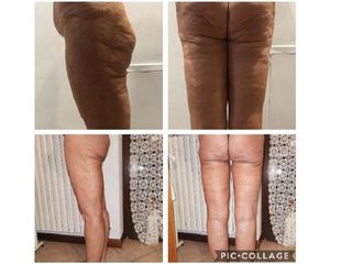 Cellulite prima e dopo