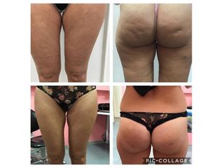 Cellulite prima e dopo