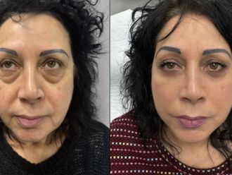 Blefaroplastica prima e dopo - 873954