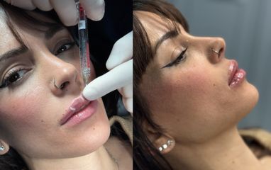 Prof. Dott. Massimiliano Giuliano Filler labbra