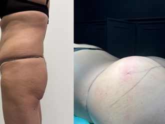 Filler Glutei prima e dopo - 873956