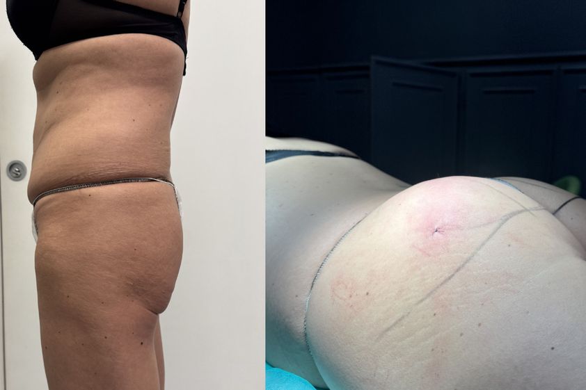 Filler Glutei prima e dopo - 873956
