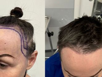 Trapianto capelli prima e dopo - 873964