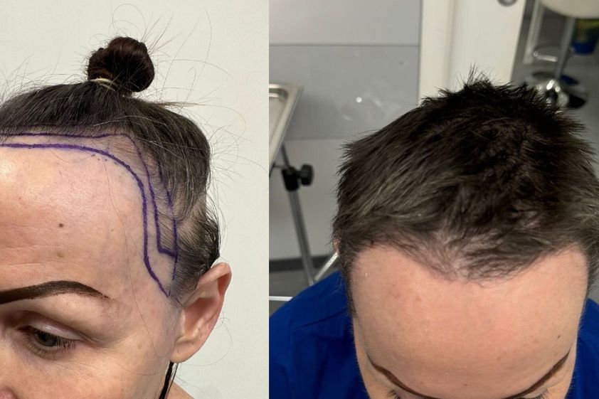 Trapianto capelli prima e dopo - 873964