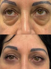 Prof. Dott. Massimiliano Giuliano Blefaroplastica