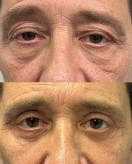 Prof. Dott. Massimiliano Giuliano Blefaroplastica