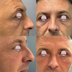 Prof. Dott. Massimiliano Giuliano Riduzione occhiaie