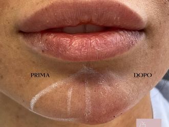 Filler prima e dopo - 878205