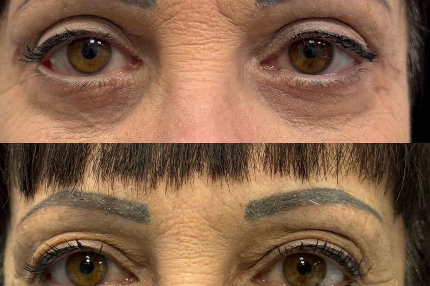 Blefaroplastica prima e dopo - 878344