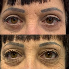 Prof. Dott. Massimiliano Giuliano Blefaroplastica superiore e inferiore