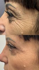 Prof. Dott. Massimiliano Giuliano Blefaroplastica superiore e inferiore