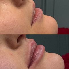 Prof. Dott. Massimiliano Giuliano Filler labbra