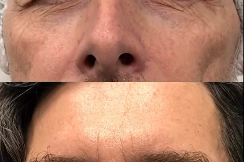 Blefaroplastica prima e dopo - 878357