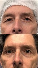 Prof. Dott. Massimiliano Giuliano Blefaroplastica