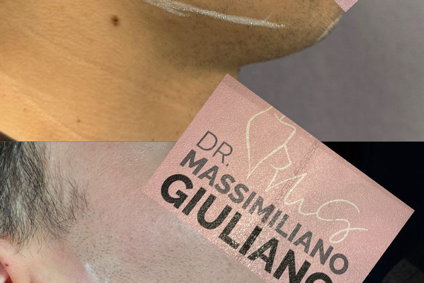 Acido ialuronico prima e dopo - 878441