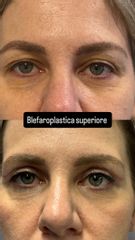 Prof. Dott. Massimiliano Giuliano Blefaroplastica superiore