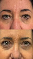 Prof. Dott. Massimiliano Giuliano Blefaroplastica