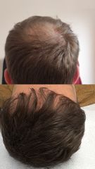 Prof. Dott. Massimiliano Giuliano trattamento PRP