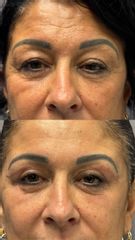 Prof. Dott. Massimiliano Giuliano Blefaroplastica superiore inferiore