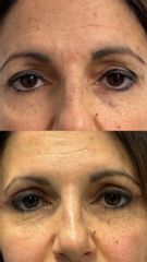 Prof. Dott. Massimiliano Giuliano Blefaroplastica