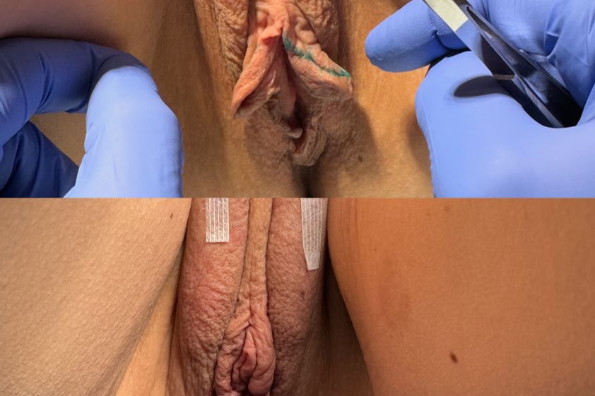 Labioplastica prima e dopo - 878934