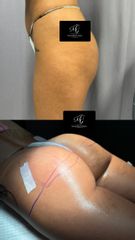 Prof. Dott. Massimiliano Giuliano Filler Gluteo