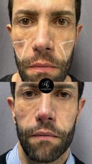 Prof. Dott. Massimiliano Giuliano Filler naturale