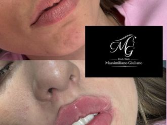 Filler labbra prima e dopo - 880368