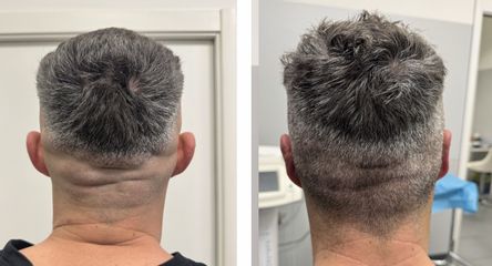 Prof. Dott. Massimiliano Giuliano Otoplastica prima e dopo