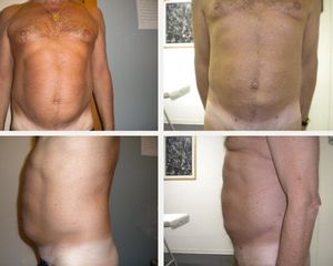 liposuzione prima dopo