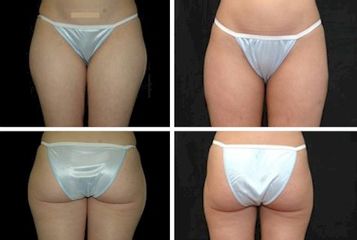 microlipocavitazione