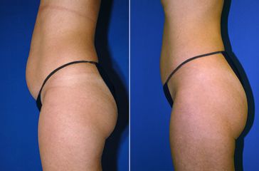 micro lipo prima e dopo