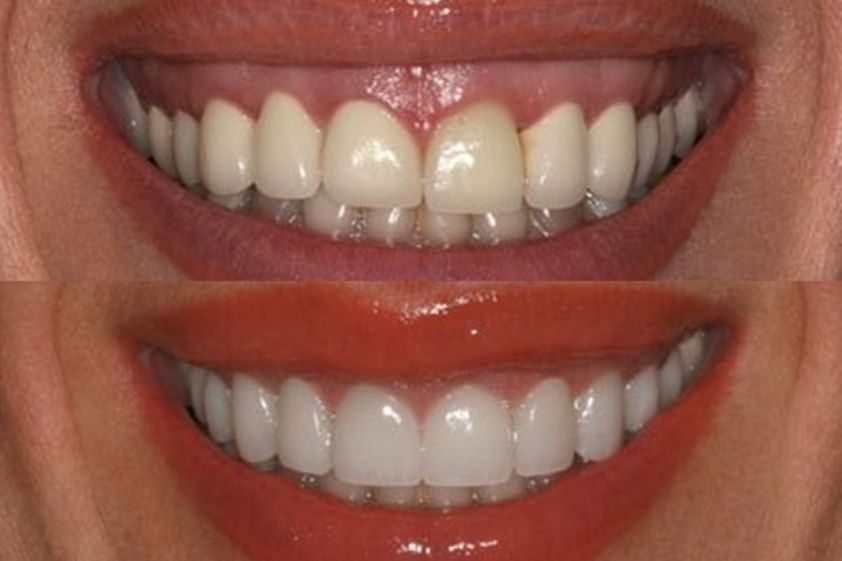 Sbiancamento denti prima e dopo - 752422