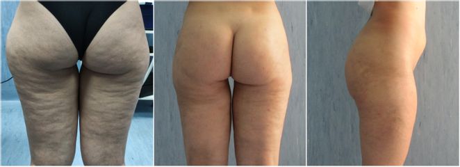 Liposuzione più lipolifting - Dott. Pasquale Raimo