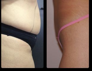 liposuzione prima dopo
