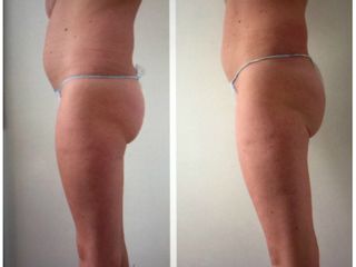 liposuzione prima dopo