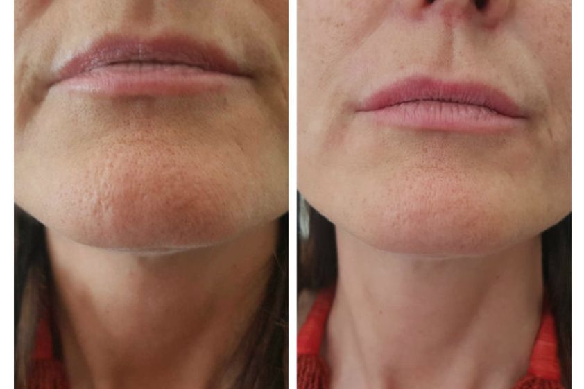 Depilazione laser prima e dopo - 767233