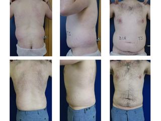 liposuzione prima dopo