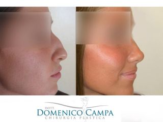 Rinosettoplastica prima e dopo